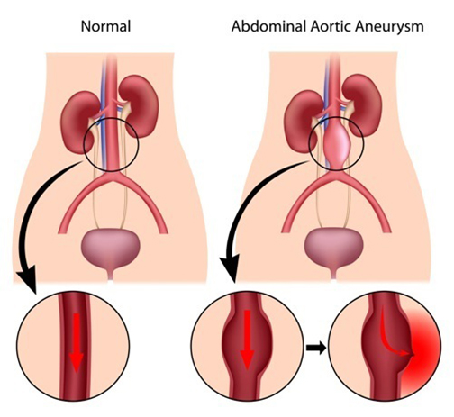 abdominal aortic aneurysm